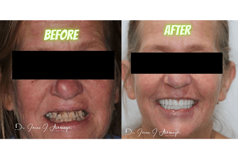 Full Mouth Dental Implants Jacksonville, FL Blue Sky Dental Group